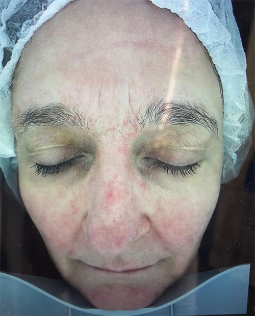 Femme après le traitement visage